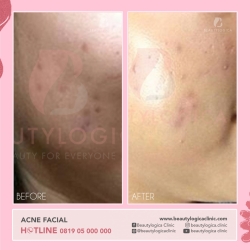 ACNE-FACIAL