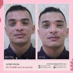 ACNE-FACIAL-02