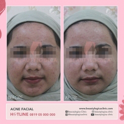 ACNE-FACIAL-03