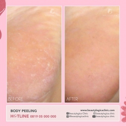 BODY-PEELING-02