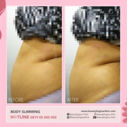 BODY-SLIMMING