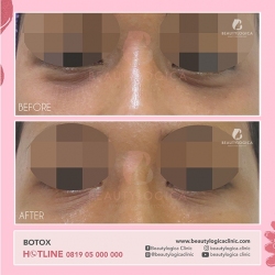 BOTOX-06
