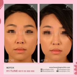 BOTOX-09
