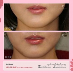BOTOX-10-b