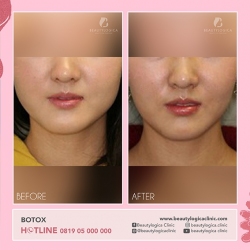 BOTOX-10