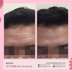 BOTOX-11