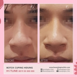 BOTOX-12
