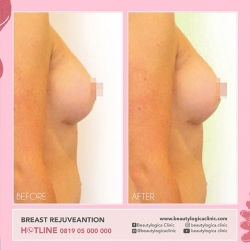 BREAST-REJUVEANTION-01