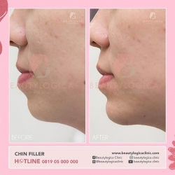 CHIN-FILLER-01