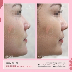 CHIN-FILLER-02