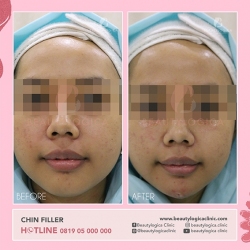 CHIN-FILLER-03