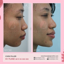 CHIN-FILLER-04