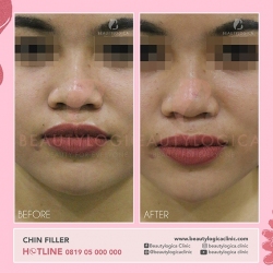 CHIN-FILLER-05