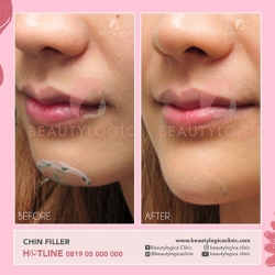 CHIN-FILLER-06