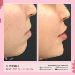 CHIN-FILLER-07