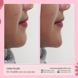 CHIN-FILLER-08
