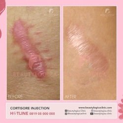 CORTISORE-INJECTION-01