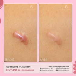CORTISORE-INJECTION-02