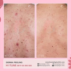 DERMA-PEELING-01