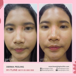 DERMA-PEELING-02