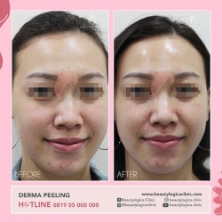 DERMA-PEELING-04