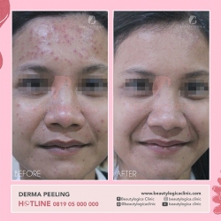 DERMA-PEELING-05