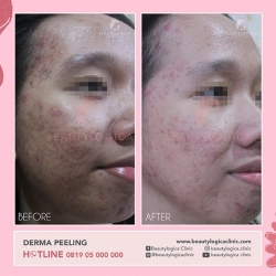 DERMA-PEELING-06