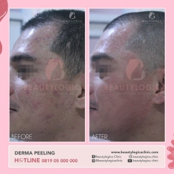 DERMA-PEELING-07