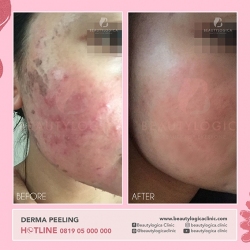 DERMA-PEELING-08