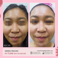 DERMA-PEELING-09
