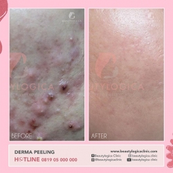 DERMA-PEELING-10