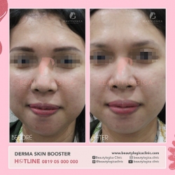DERMA-SKIN-BOOSTER-01