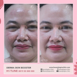 DERMA-SKIN-BOOSTER-02