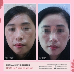 DERMA-SKIN-BOOSTER-03