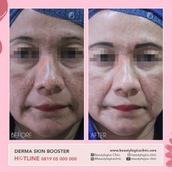 DERMA-SKIN-BOOSTER-04