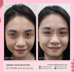 DERMA-SKIN-BOOSTER-06