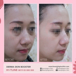 DERMA-SKIN-BOOSTER-07