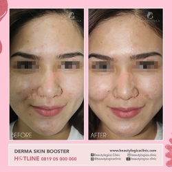 DERMA-SKIN-BOOSTER-08