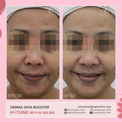 DERMA-SKIN-BOOSTER-09