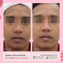 DERMA-SKIN-BOOSTER-10