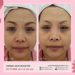 DERMA-SKIN-BOOSTER-11