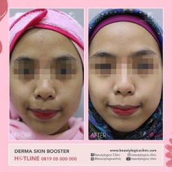 DERMA-SKIN-BOOSTER-12