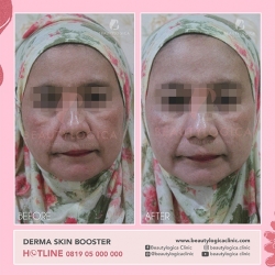DERMA-SKIN-BOOSTER-13