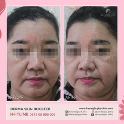 DERMA-SKIN-BOOSTER-14