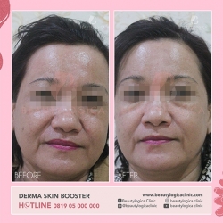 DERMA-SKIN-BOOSTER-15