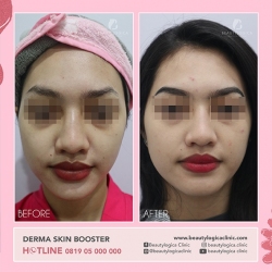 DERMA-SKIN-BOOSTER-16