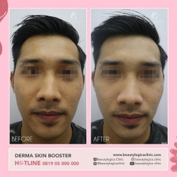DERMA-SKIN-BOOSTER-17
