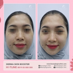 DERMA-SKIN-BOOSTER-18
