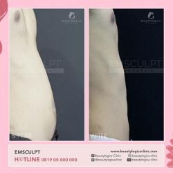 EMSCULPT-10