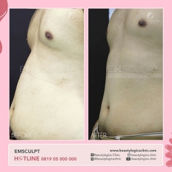 EMSCULPT-12